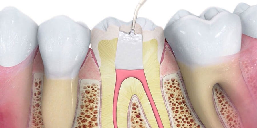 Root Canal Treatment North York