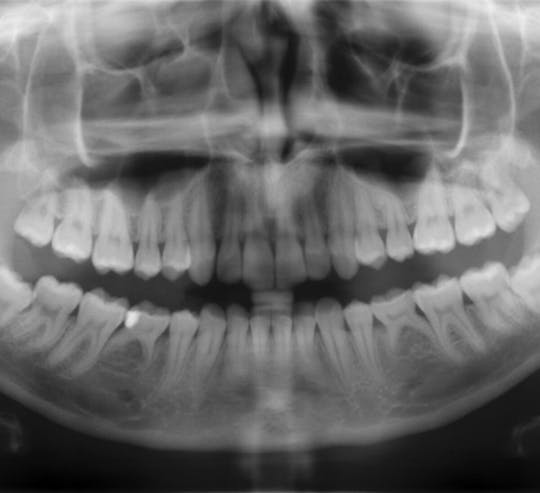 Digital Panoramic X-Ray - Technology - Dentist North York - Sky Dental